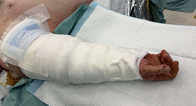 Šest až deset hodin bez ruky. V Brně lékaři muži přišili utrženou paži včas